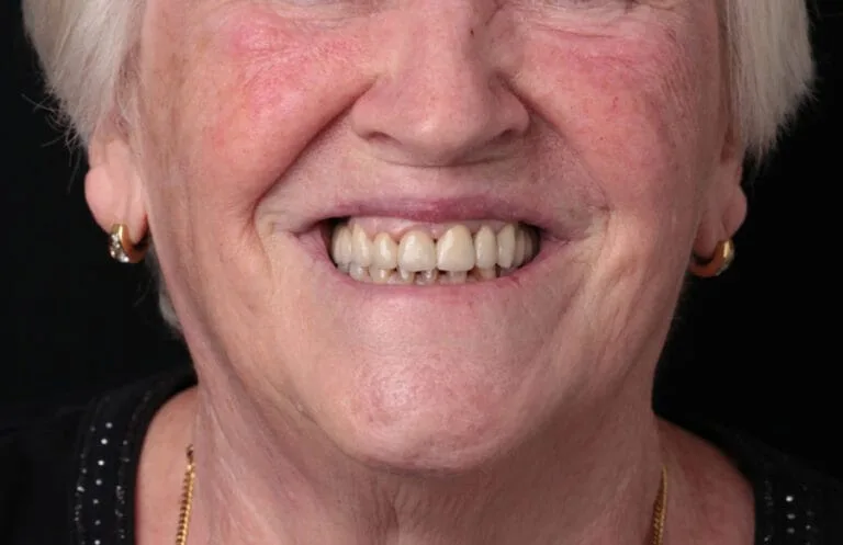 After — Dental implants