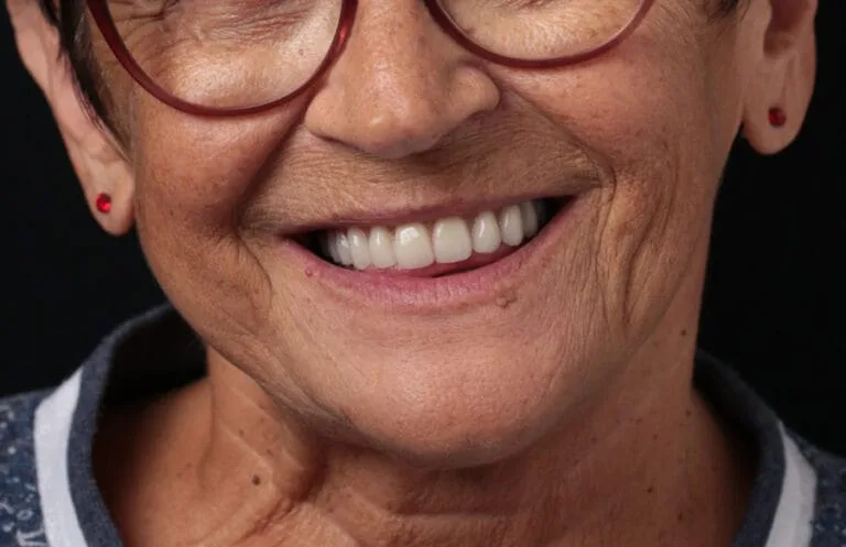 After — All-on-4 fixed teeth