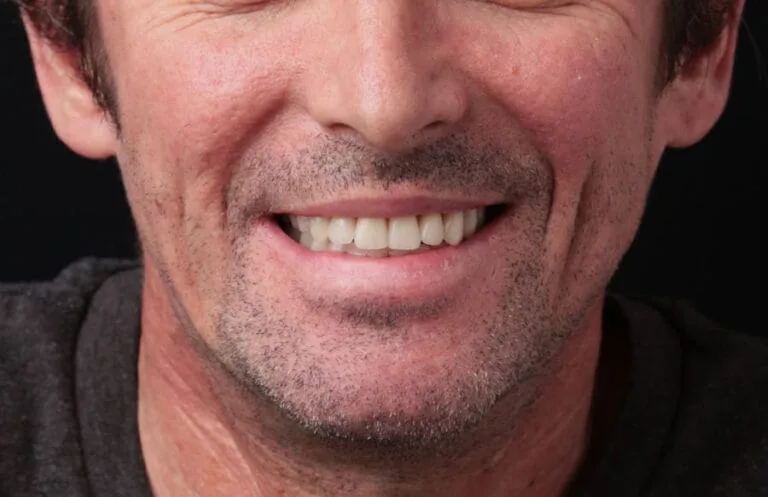 After — Dental prosthetics