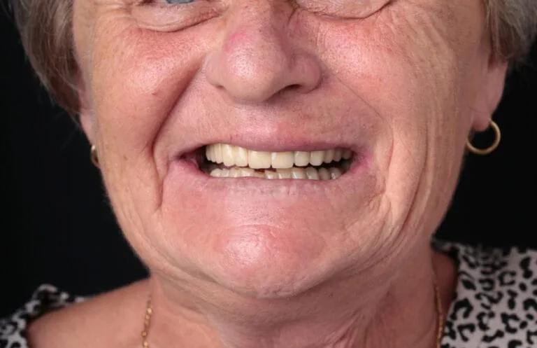 After — Full-mouth care