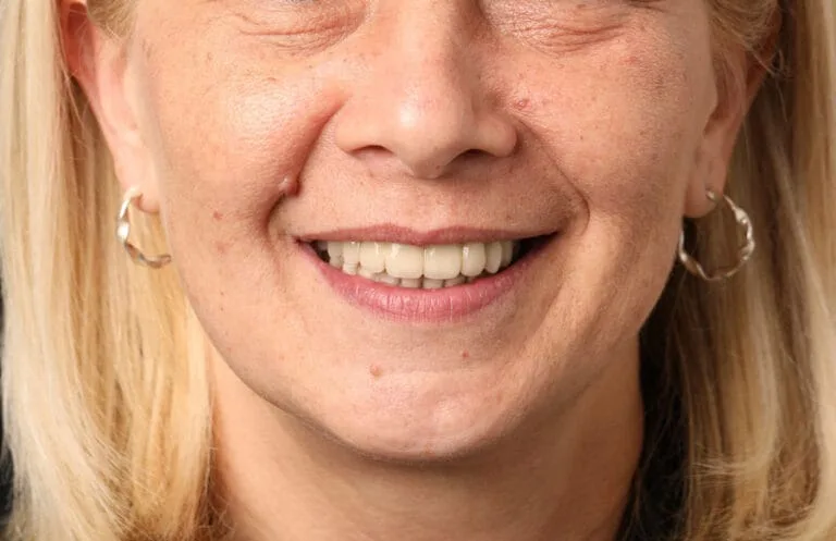 After — Smile makeover