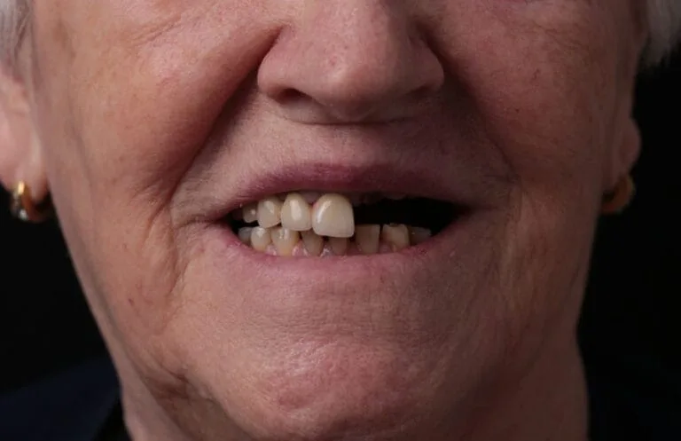 Before — Dental implants