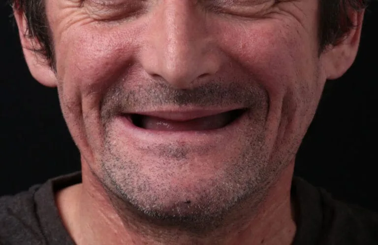 Before — Dental prosthetics