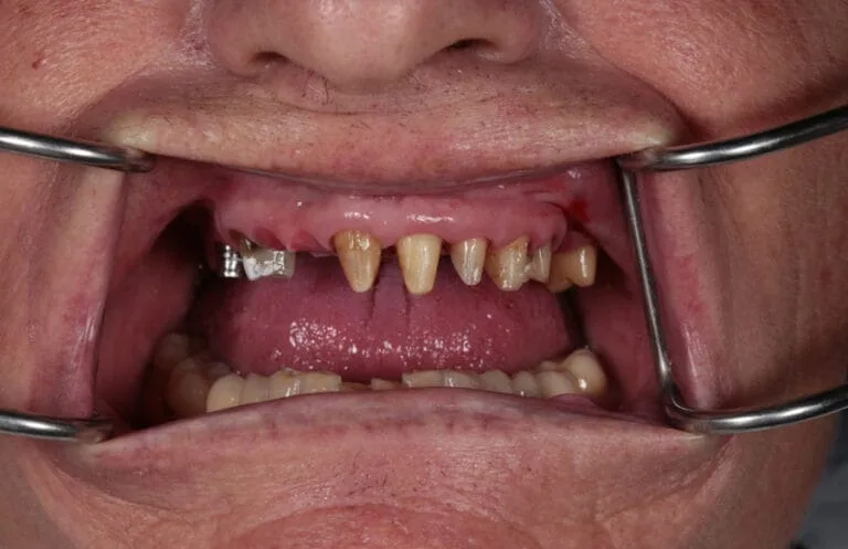 Before — Full-mouth care