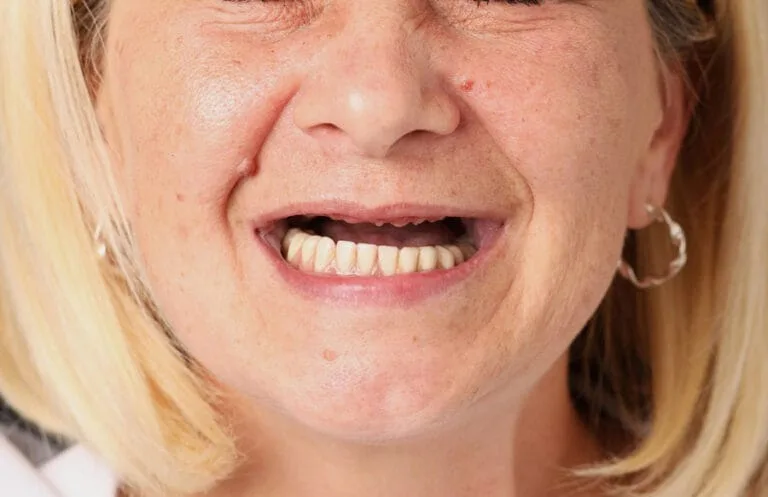 Before — Smile makeover