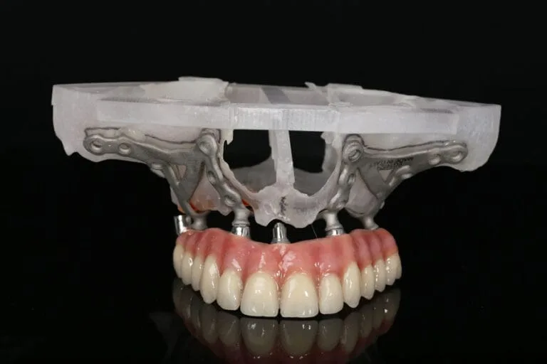 Subperiostale Implantate
