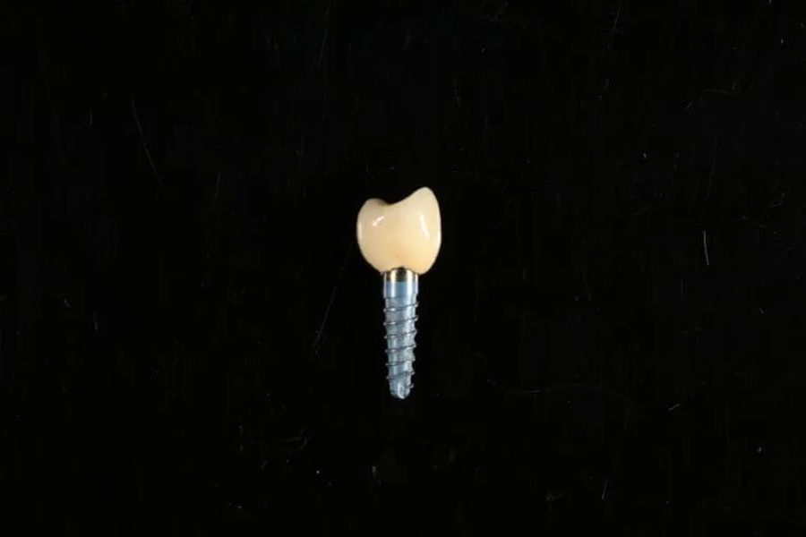 Dental implants in Slovenia or Croatia? An honest comparison of prices and risks (2026)