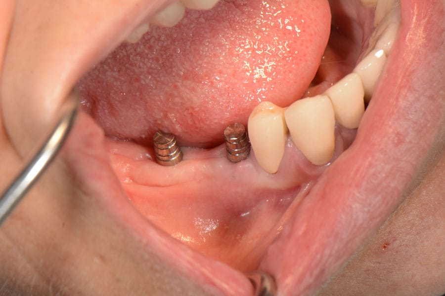 Jamstvo na zubne implantate — što plaćate i što dobivate (2026)